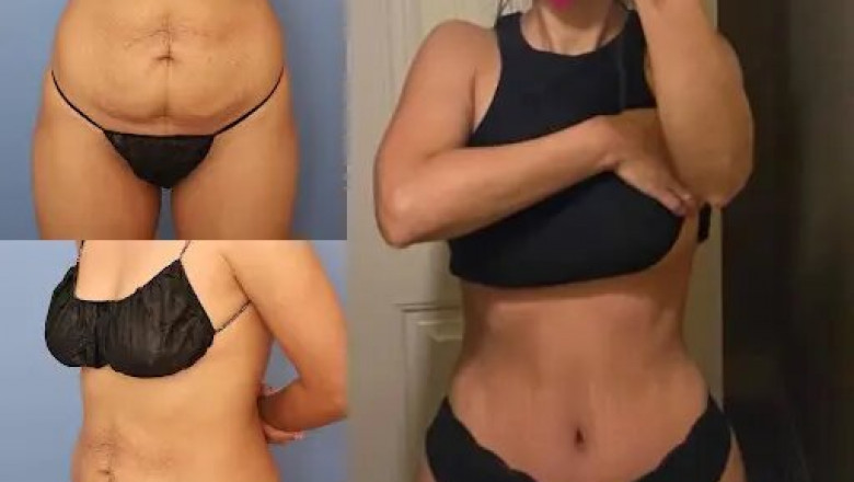 Tummy Tuck in Dubai: A Complete Guide for First-Time Patients