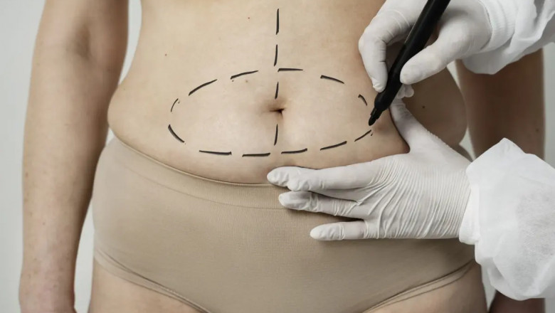 The Science Behind Fat Transfer in Dubai: Views from the Best Doctors in Dubai
