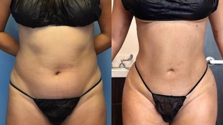 How Anesthesia Ensures a Pain-Free Liposuction Surgery Experience in Dubai