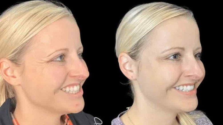 Achieve Flawless Skin with the Best Doctors in Dubai for Botox
