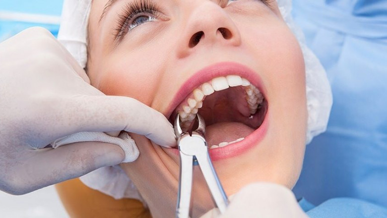 How to Deal with the Pain of Tooth Extraction: Ottawa Dental Tips