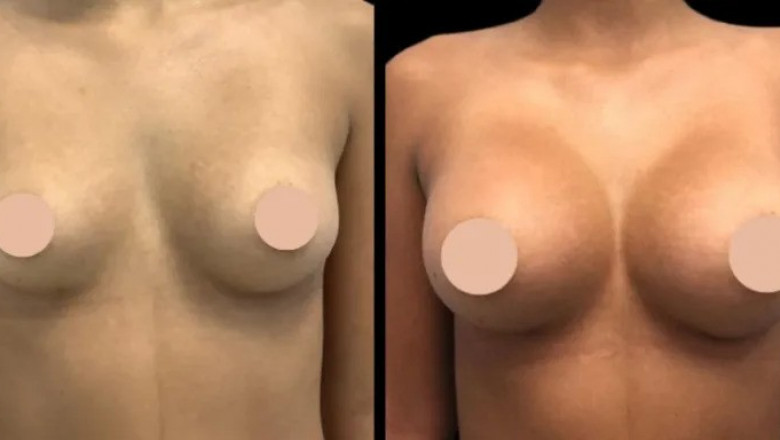 Best Breast Enlargement Surgeon in Dubai How Technology is Transforming the Field of Cosmetic Surgery