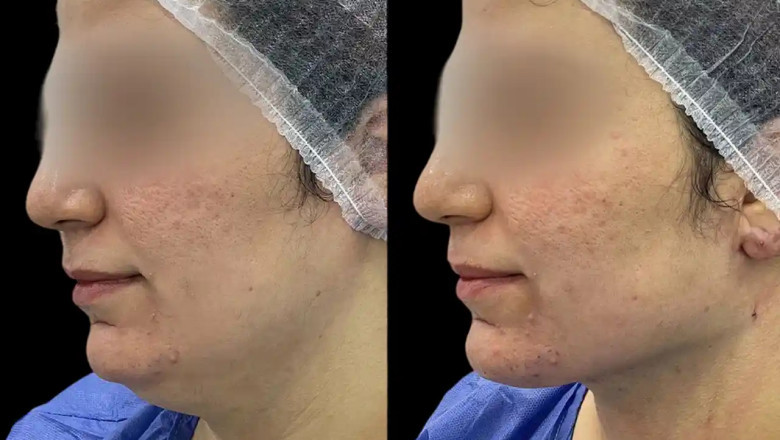 How Chin Fillers from the Best Plastic Surgeons in dubai Can Change Your Look