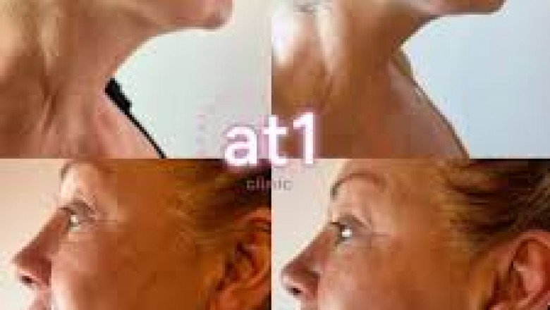 Rediscover Confidence with Body Aesthetics & Non-Surgical Face Lifts in Nottingham