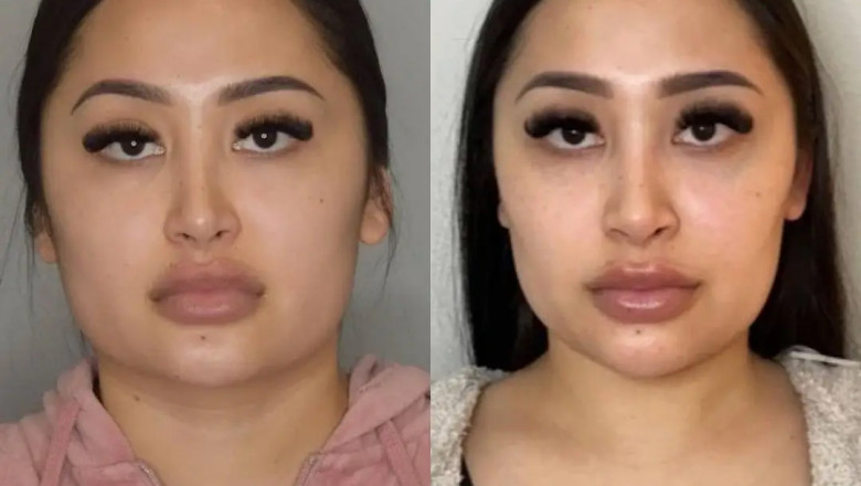 Before and After: Real Results of Buccal fat removal Surgery in dubai
