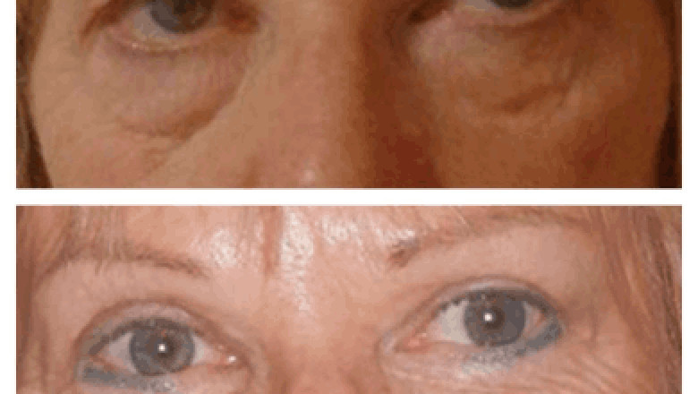 Best Recovery Tips After Eye bag removal Surgery in dubai
