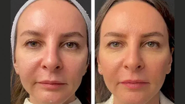 Safety and Effectiveness of Mesotherapy Treatments in Dubai