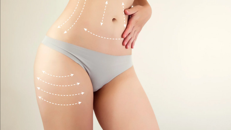 Refining Beauty Your Ultimate Guide to Best Liposuction Doctors in Dubai