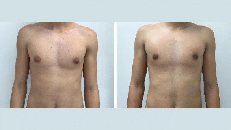 Long-Term Effects of Untreated Gynecomastia in Dubai