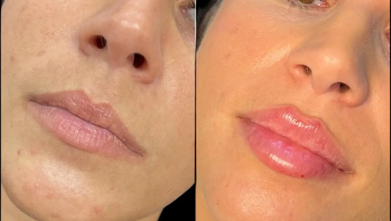Best Doctors in Dubai for Fillers Offering Latest Techniques