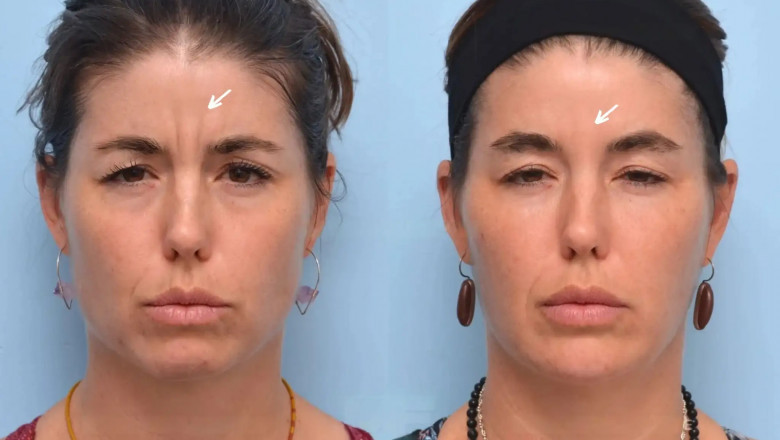 Best Aesthetic Clinic in Dubai: Safe and Effective Botox Procedures You Can Trust