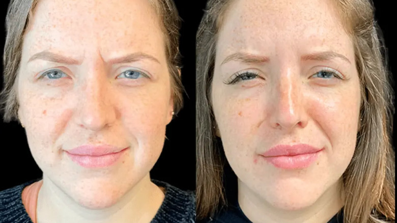 Botox in Dubai for Migraine Relief: What the Experts Are Saying