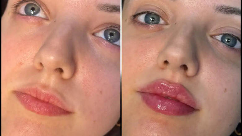 Fillers in Dubai Provide Results That Can Last from 6 Months to Over a Year, Depending on the Type Used