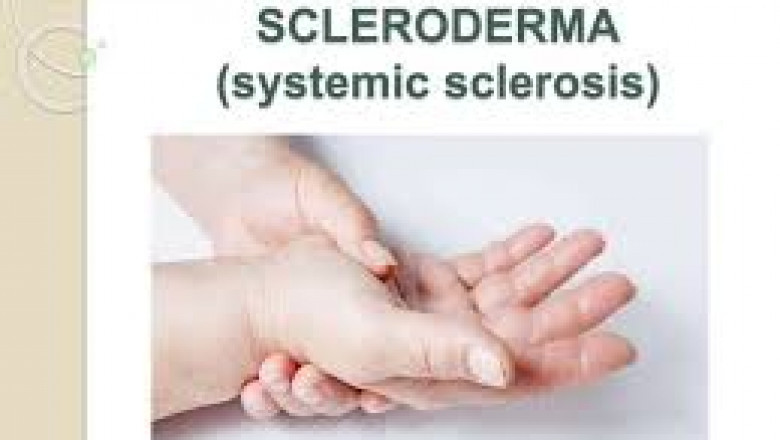 Emerging Trends in Global Systemic Scleroderma Treatment Market Forecast to 2030 – 2025