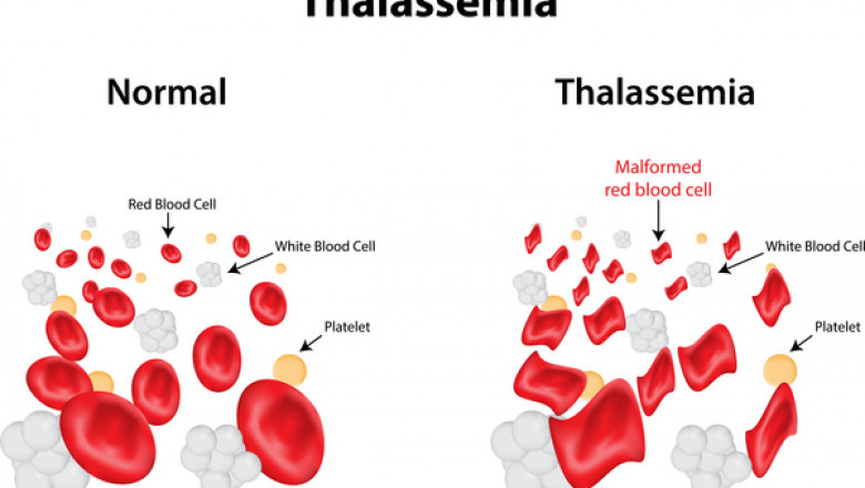 Global Beta-Thalassemia Market Insights, Drivers, and Future Scope Report 2030