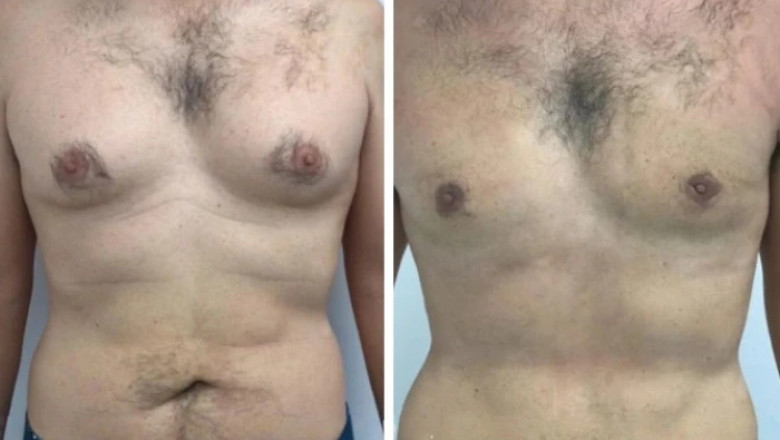 Gynecomastia in Dubai: Common Questions Answered