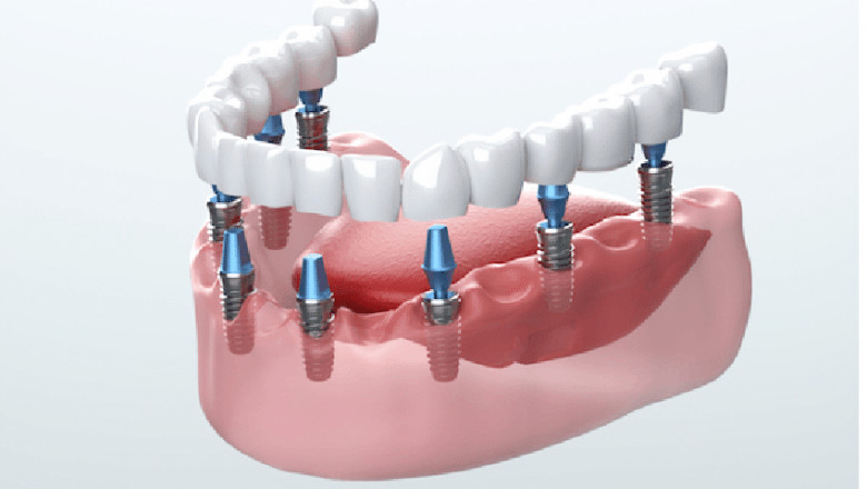 Dental Fillings, Crowns, Bridges, and Implants: Restoring Your Healthy Smile