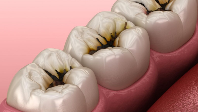 Dental Fillings - The Unsung Heroes of Tooth Decay Treatment