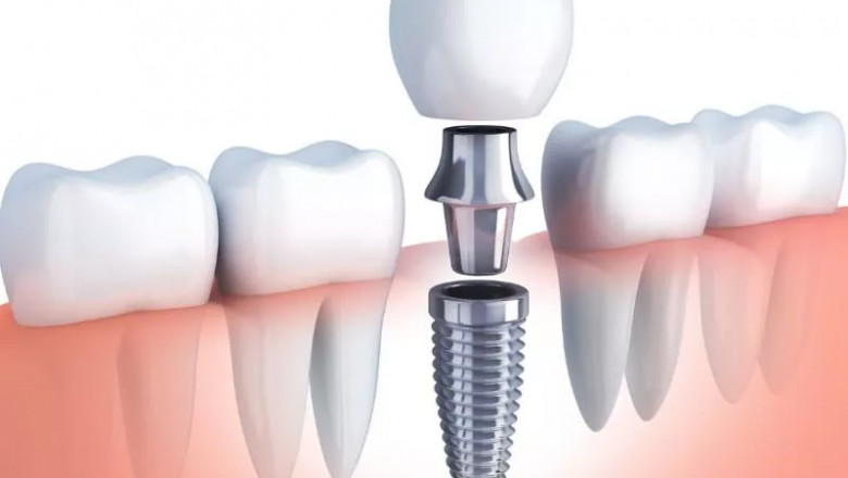 Dental Implants - How Much Do They Cost?