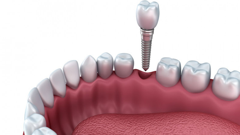 Dental Implants - The Modern Solution For Tooth Loss