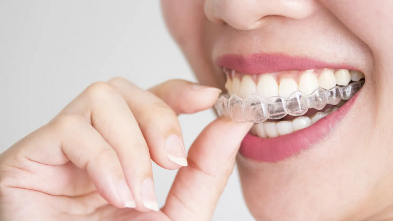 Invisalign Norcross, GA: Clear, Comfortable, and Effective Teeth Straightening