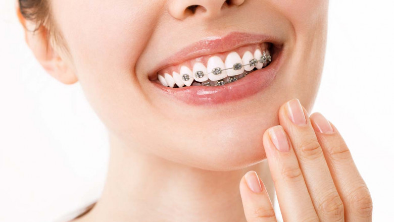 Orthodontic Treatment for Adults: Improve Your Smile and Oral Health