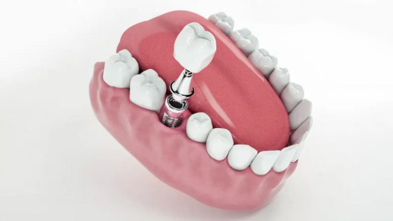 The Benefits of Full Mouth Dental Implants for Oral Health and Comfort