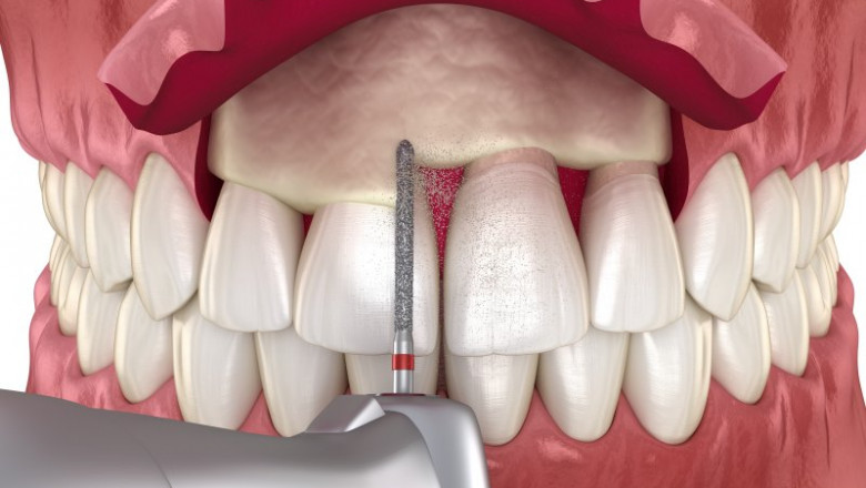What is Crown Lengthening?