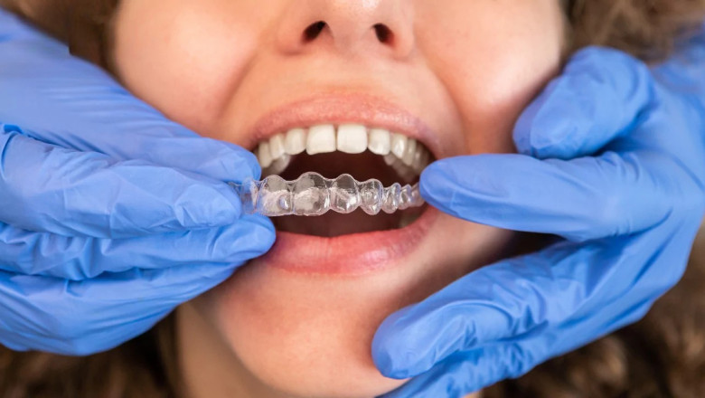 What to Expect During Your Invisalign Treatment in Dubai