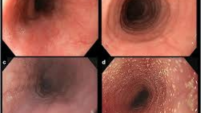 Rising Prevalence Driving the Eosinophilic Esophagitis Market Globally: Forecast 2021 - 2030