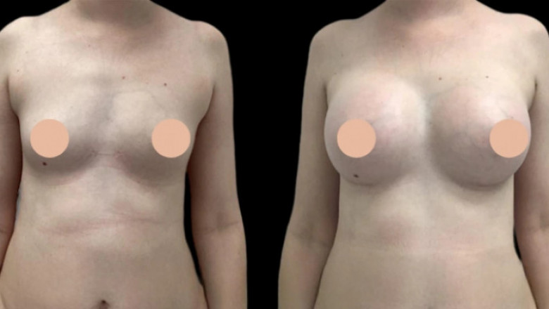Redefining Beauty: The Best Breast Augmentation Surgeon in Dubai