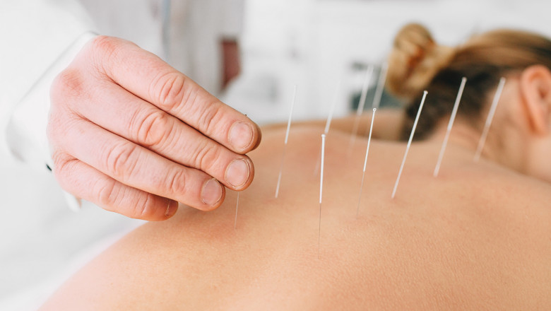 Healing Naturally: Acupuncture Calgary South Services