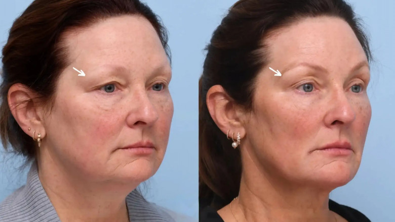 How to Choose the Best Aesthetic Clinics in Dubai for Botox Treatments