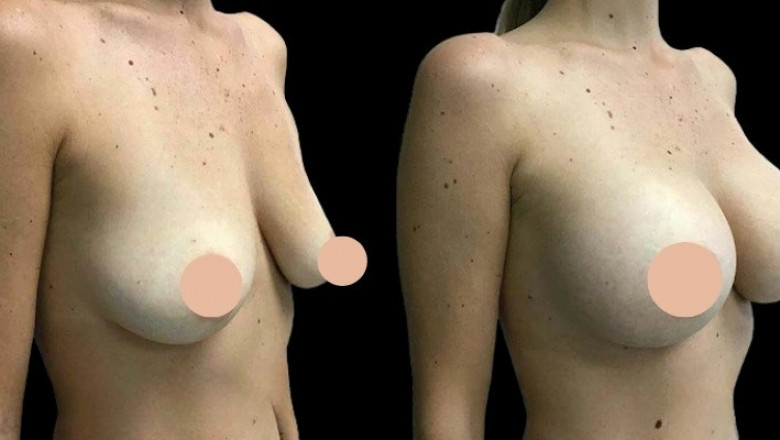 Breast Augmentation in Dubai: Post-Surgery Care Tips for a Smooth Recovery