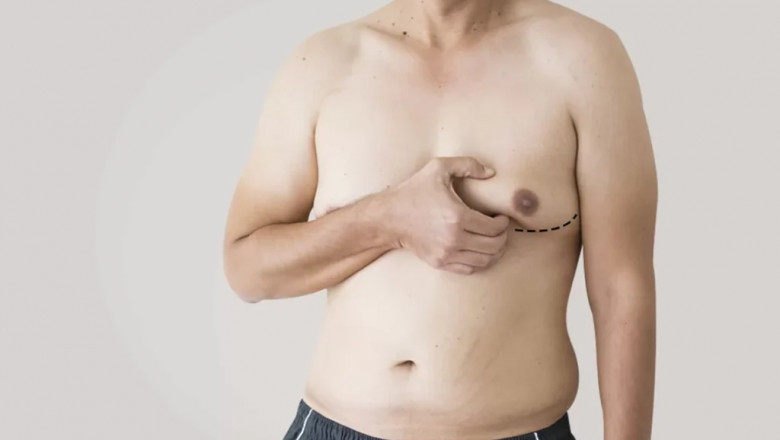 Patient Experiences: Islamabad Gynecomastia Recovery Stories