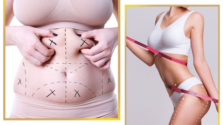 Is Liposuction in Islamabad Right for You? Key Considerations