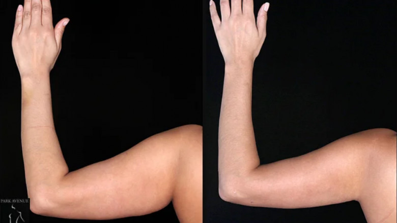 In this post, we will explore the most effective arm liposuction after care practices that help support your recovery and achieve your desired results.