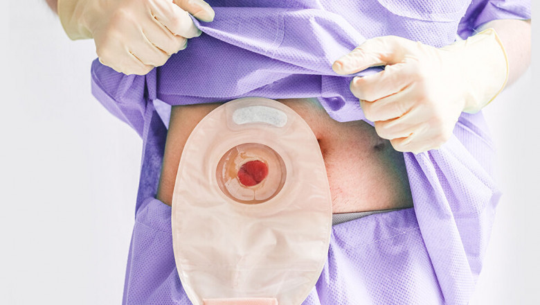 OstomyStoma Care Market Opportunities Expanding with Personalized Products and Smart Health Technologies
