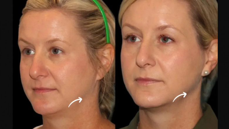 Combining Wellness and Sculptra Fillers—Best Plastic Surgeon in Dubai’s Holistic Method