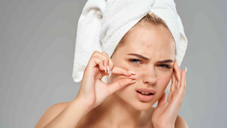 Get Clear Skin Confidence: Isotroin 10mg for Pimple Treatment