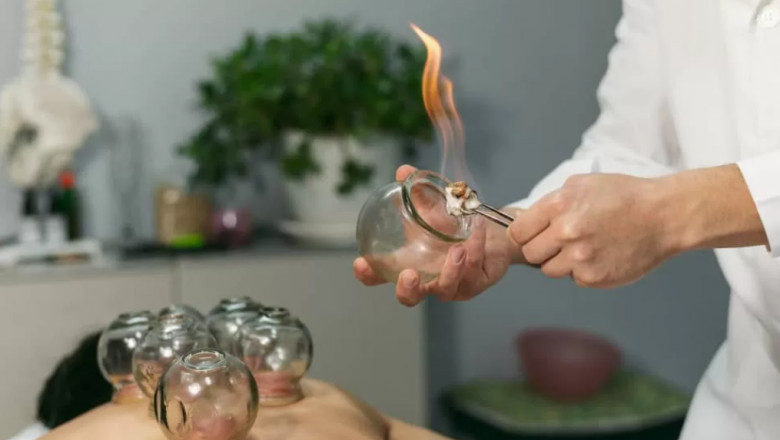 Discover the Healing Power of Dry Cupping Therapy at Dynasty Clinic