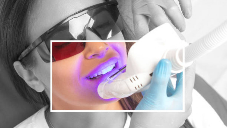 Riyadh’s Top Teeth Whitening Experts Reveal 2025’s Newest Methods