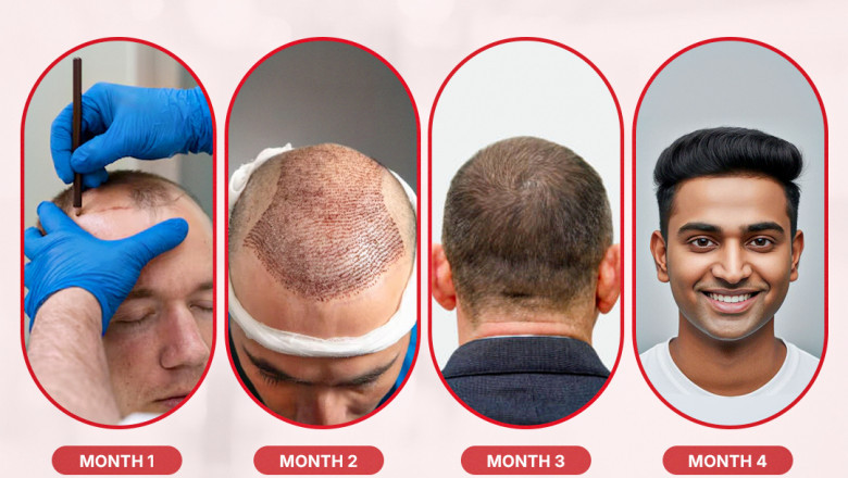 What to Expect Before, During, and After Your Hair Transplant Procedure