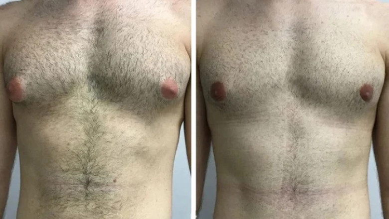 Gynecomastia in Dubai: Understanding the Causes and Symptoms