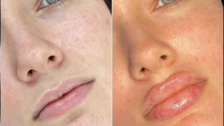Best Aesthetic Clinics in dubai for Fillers: Achieve a Youthful Look Without Surgery