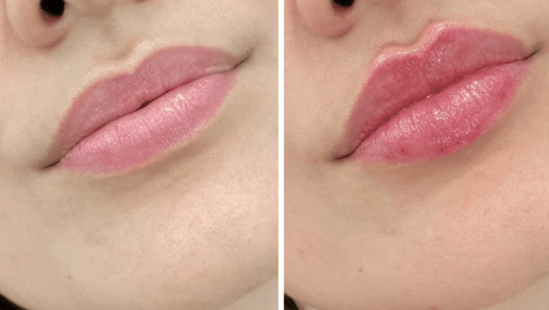 Best Plastic Surgeon in dubai: How to Avoid Overfilled Look with Dermal Fillers
