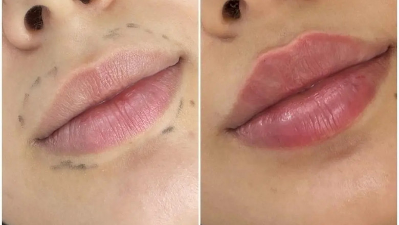 How to Prepare for Your Dermal Filler Appointment: A Guide from the Best Doctors in dubai