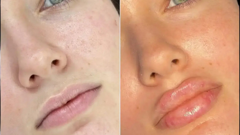 The Most Reliable Best Doctors in Dubai for Fillers