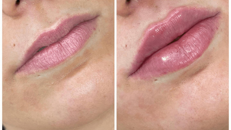 Long-Term Effects of Repeated Juvederm treatment in Dubai