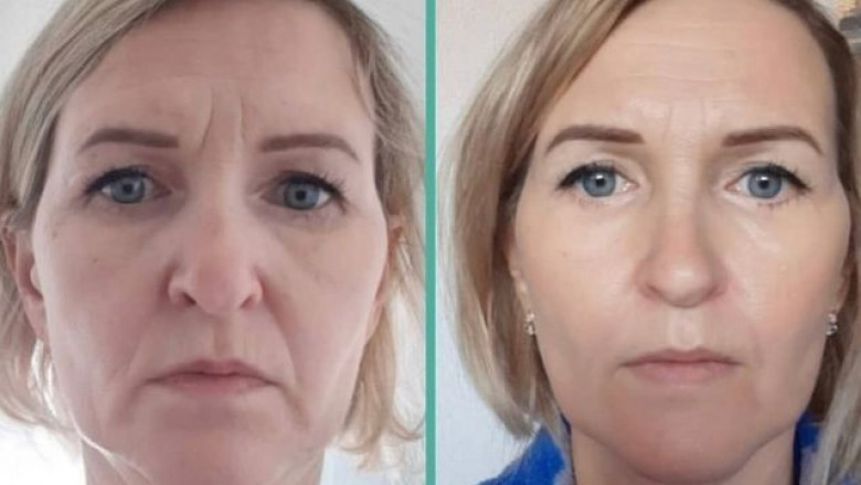 Reclaim Your Youth Discover the Power of 7D HIFU Facial Treatment